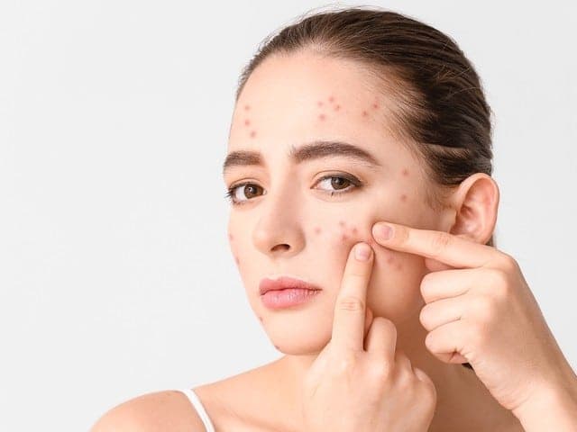 ব্রণ দূর করার উপায়: কার্যকর Acne Solution ও K-beauty স্কিন কেয়ার টিপস